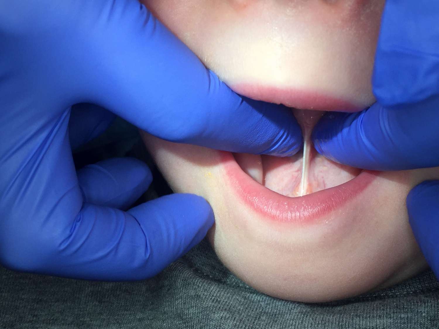 A Parent's Guide to TongueTie Heart & Soul Speech